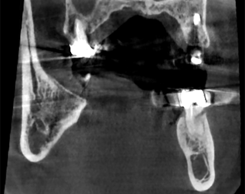 ART-V - Artifact Reduction Technology of Vatech